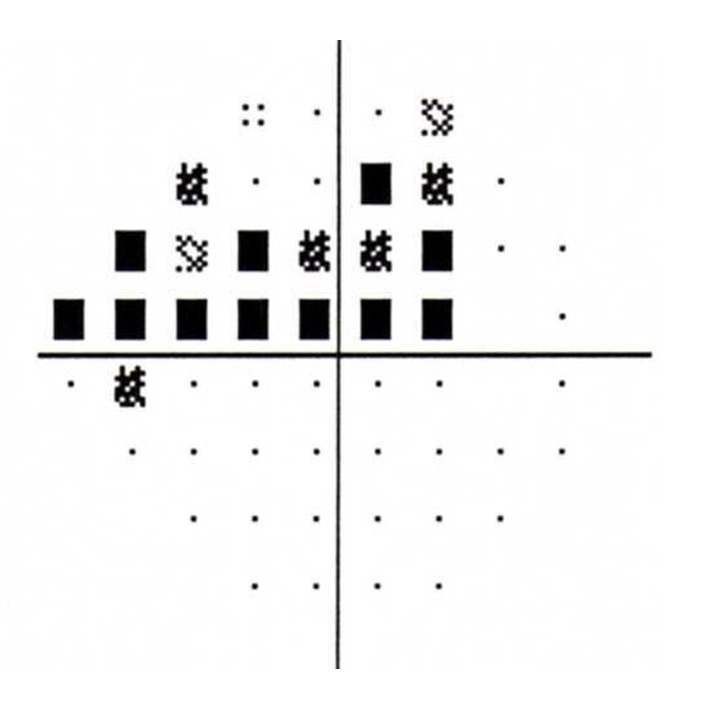 test results showing Superior arcuate visual field loss from glaucoma